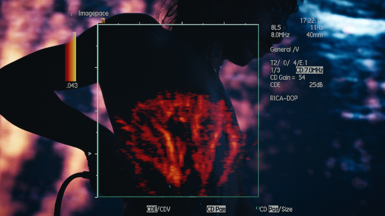 Phantom Limb at Beating Heart 2025